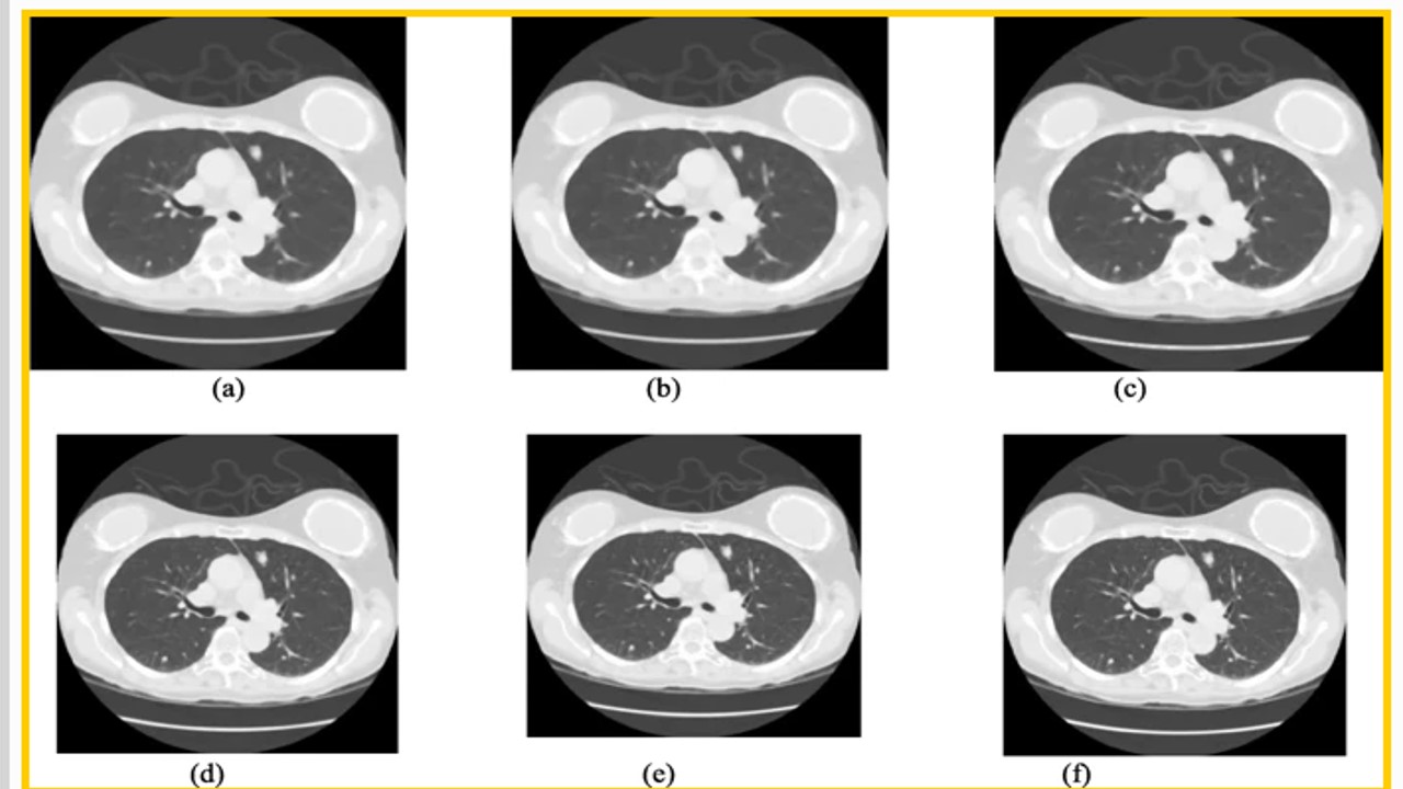 deep-learning-for-lung-cancer-detection-and-classification-article